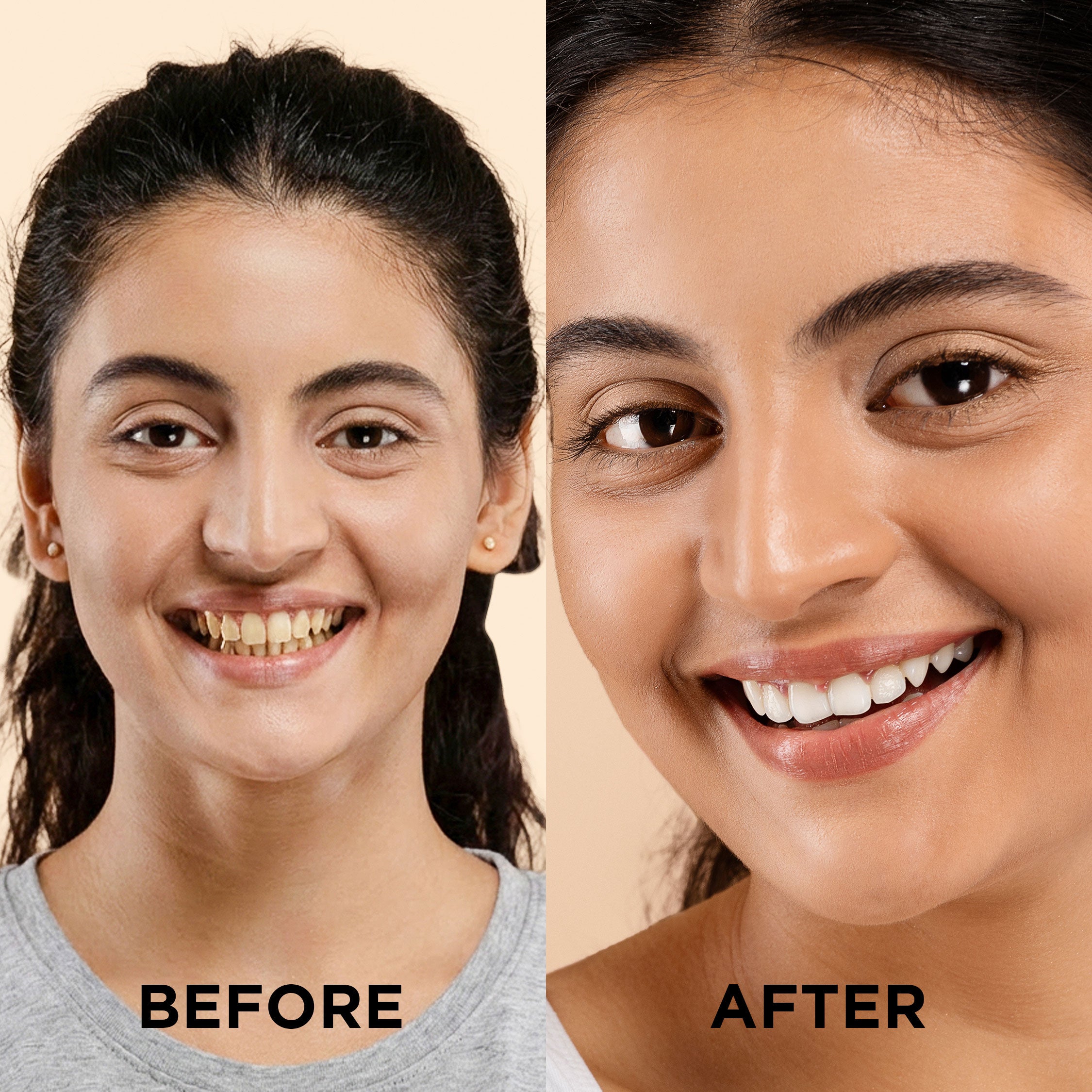 Gentle Dental – Teeth Whitening Powder